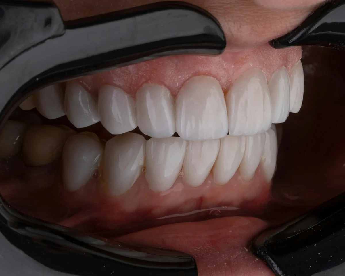How Fluoride Treatments Protect Your Teeth