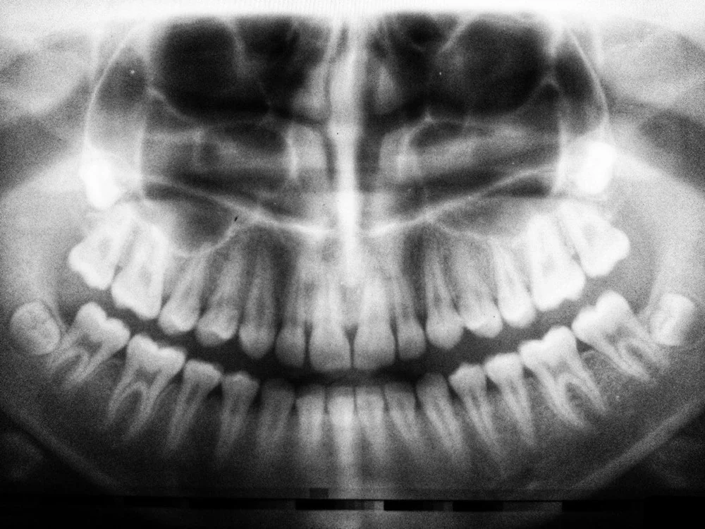 Protect Your Teeth